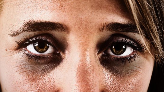El origen de las ojeras