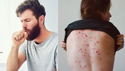 Coronavirus y viruela de mono: cuál tiene mayor potencial de propagación. Coronavirus y viruela de mono: cuál tiene mayor potencial de propagación.