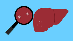 La SAP emitió un alerta sobre el brote de hepatitis de origen desconocido. ¿Qué advirtieron? (Foto: Pixabay) La SAP emitió un alerta sobre el brote de hepatitis de origen desconocido. ¿Qué advirtieron? (Foto: Pixabay)